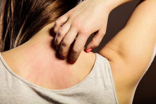 allergy 