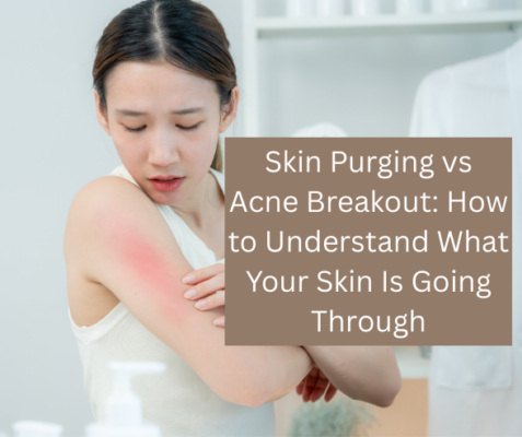 Skin Purging vs Acne Breakout